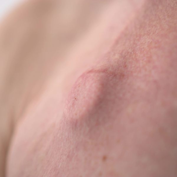 port example Benign Prostatic Hyperplasia