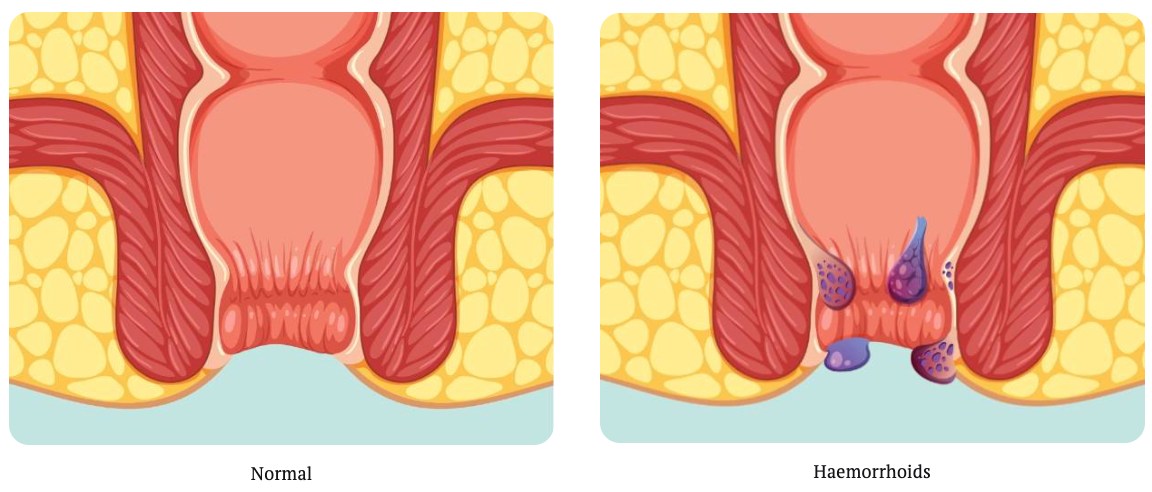 Haemorroids Normal vs inflamed Haemorrhoidal Artery Embolisation (HAE)
