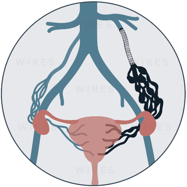 Ovarian Vein Embolisation