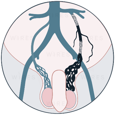 Varicocoele Embolisation Varicocoele Embolisation