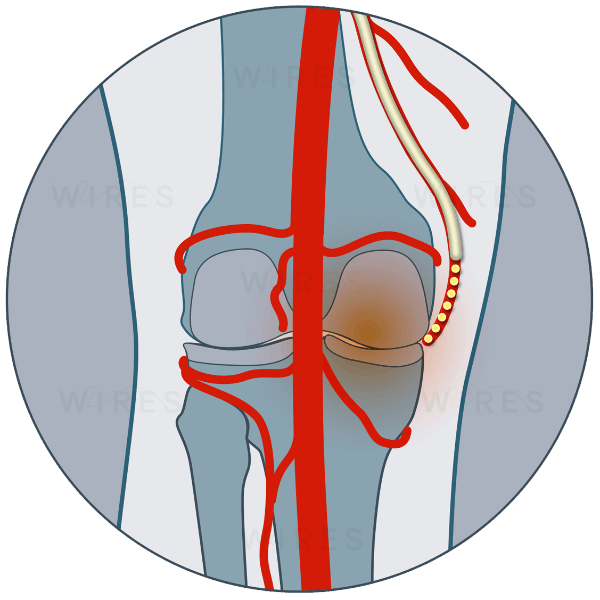 Osteoarthritis