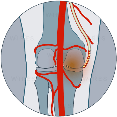 Knee Embolisation