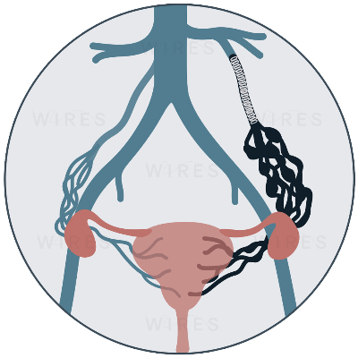 ovarian_vein-embolisation ovarian vein embolisation