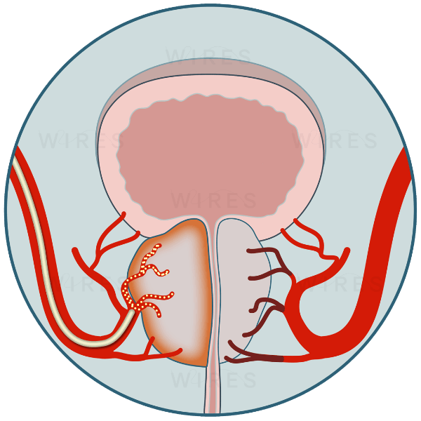 Benign Prostatic Hyperplasia 