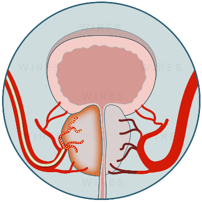 prostate_artery_embolisation prostate artery embolisation