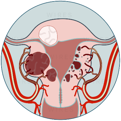 uterine-artery-embolisation uterine artery embolisation