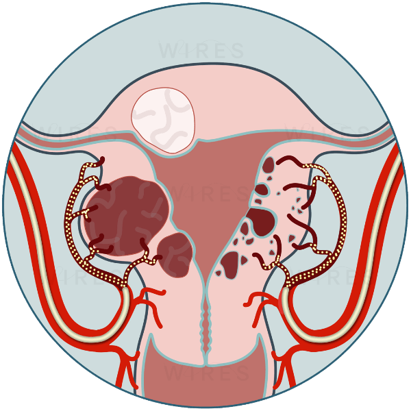 uterine fibroids 600 Uterine Artery Embolisation Melbourne